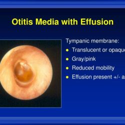 Soap note for acute otitis media